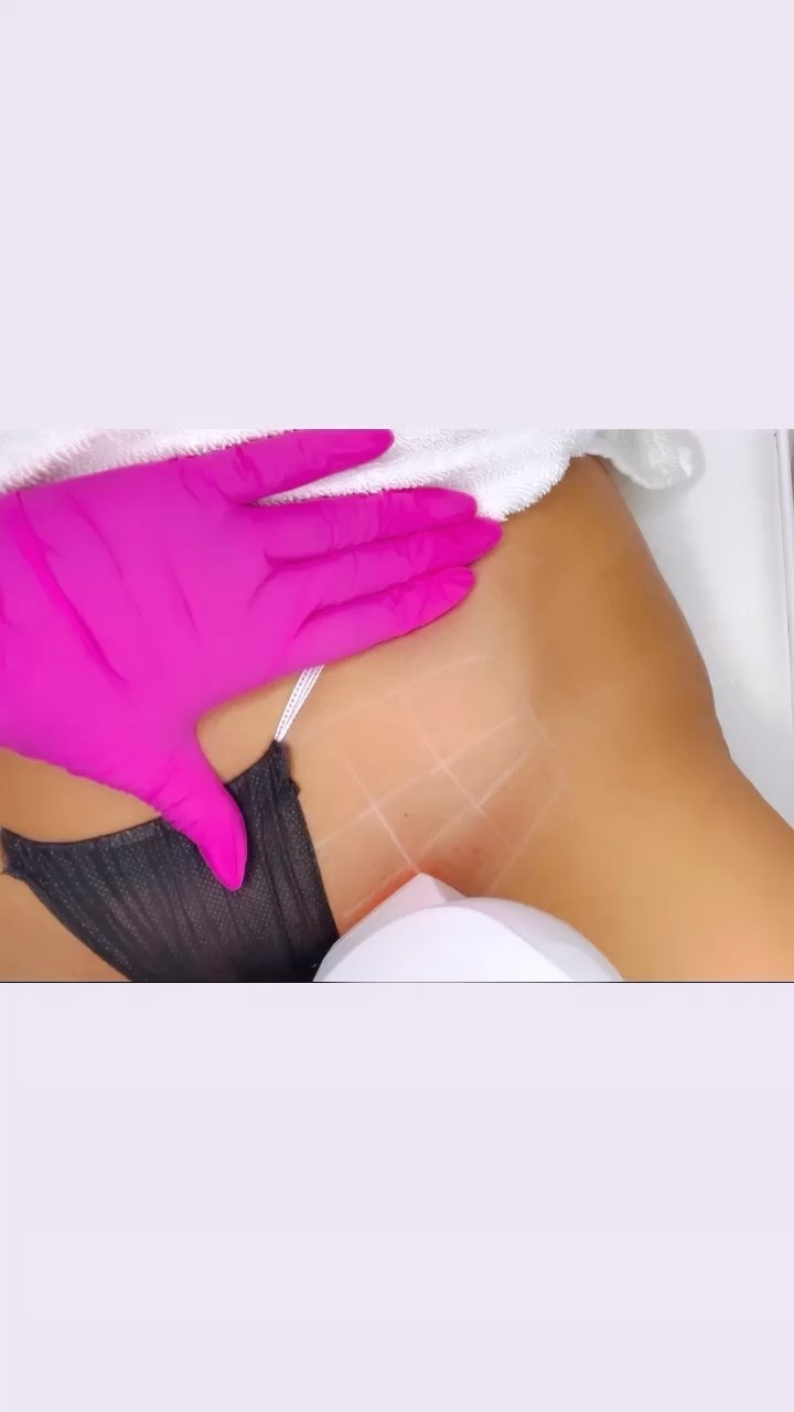 LASER HAIR REMOVAL 
Remove Hair Permanently Safe & Effective 
Tired of shaving every day? Having trouble with ingrown hairs, bumps, cuts, hyperpigmentation and infections?
Laser hair removal is the safest, most effective way to be rid of unwanted hair, permanently.
✅ Bikini
✅ Brazilian 
✅ Abdomen 
✅ Legs 
✅ Back / Chest 
✅ Neck 
✅ Arms 
EXCLUSIVE PROMO! 
Buy 2 Hair Removal treatments, Get the 3rd FREE! 
#painfree#nodowntime#softskin
#guaranteed#fastresults 
📲 519-636-3575 
📍London, Ontario 
Book your FREE consultation